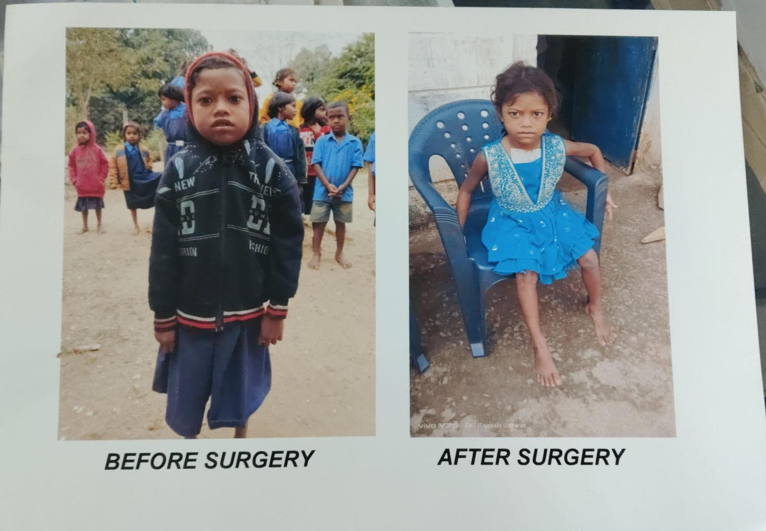 चिरायु एक वरदान- हृदय रोग से पीडित दिव्या ऑपरेशन के बाद जी रही है सामान्य जिन्दगी